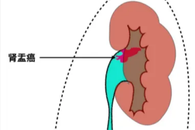 反复尿血，可能是肾盂癌！泌尿外科团队微创手术斩获「真凶」