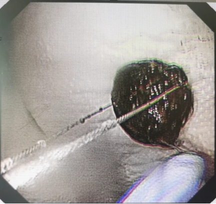 话梅一下肚，肠子堵住了怎么办？74 岁嗲嗲经历了这样的事情……