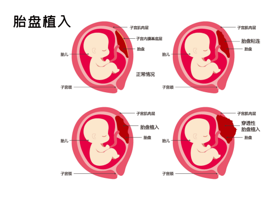 胎盘植入的发病原因有哪些？