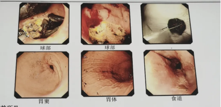 话梅一下肚，肠子堵住了怎么办？74 岁嗲嗲经历了这样的事情……