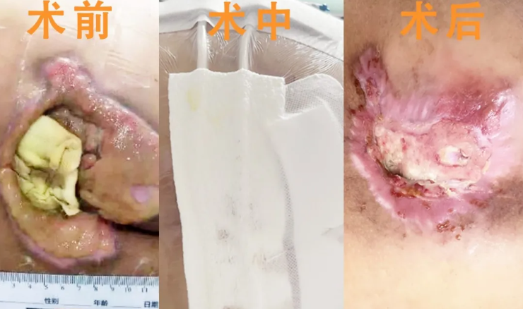 承德县医院普外科新技术，为压疮患者去腐生肌
