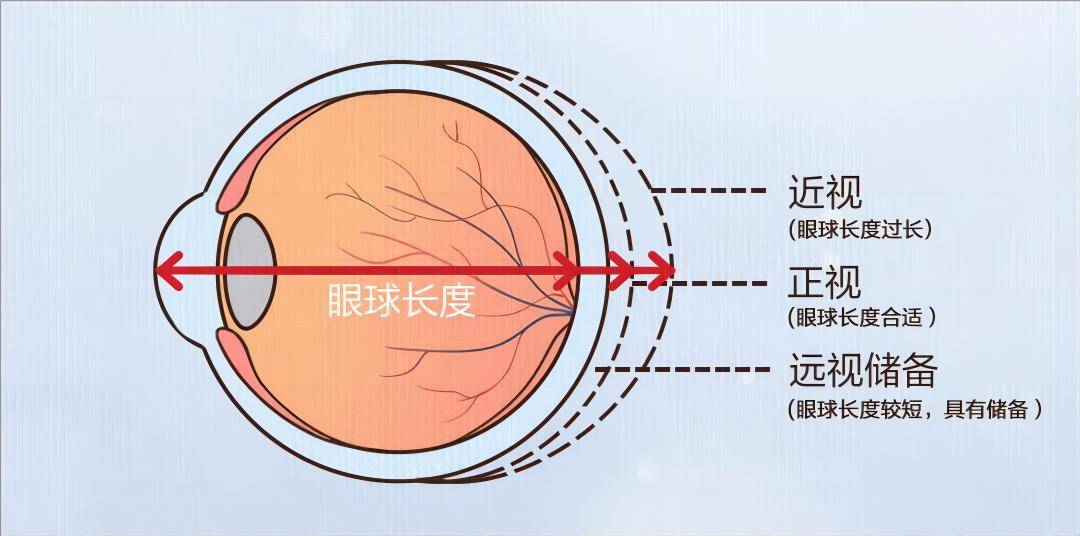 那么多黑科技，有逆转近视的吗？湖北普瑞眼科医院解答