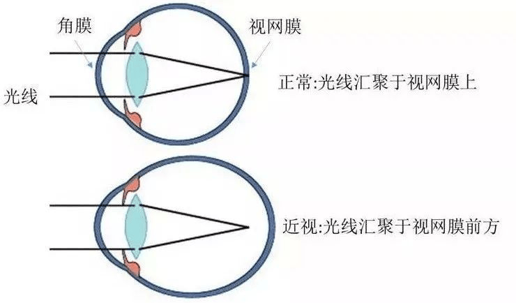 那么多黑科技，有逆转近视的吗？湖北普瑞眼科医院解答