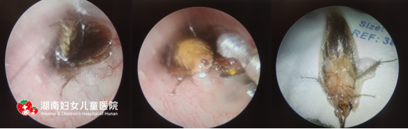 吓人！耳朵里爬进去了活蟑螂，怎么办？