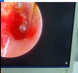 警惕耳道与鼻腔异物,守护儿童与成人健康安全