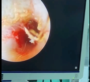 警惕耳道与鼻腔异物,守护儿童与成人健康安全