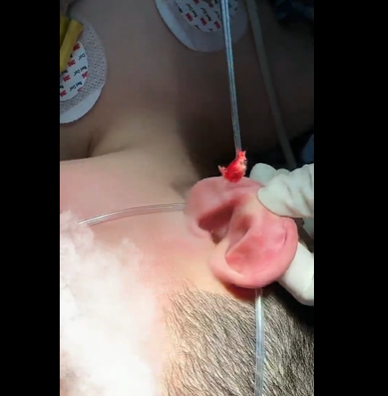 警惕耳道与鼻腔异物,守护儿童与成人健康安全