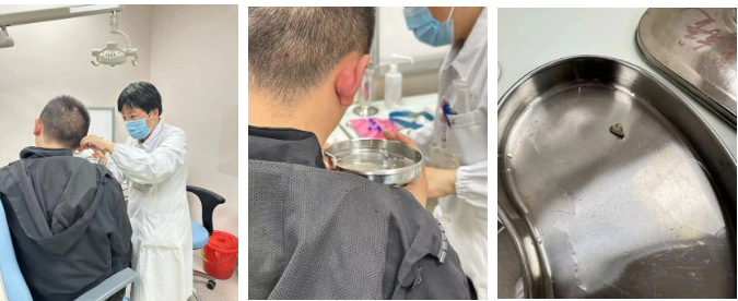 警惕耳道与鼻腔异物,守护儿童与成人健康安全