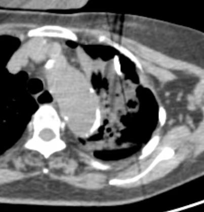 成都京东方医院成功行 CT 引导下氩氦刀冷冻消融「杀死」肿瘤细胞