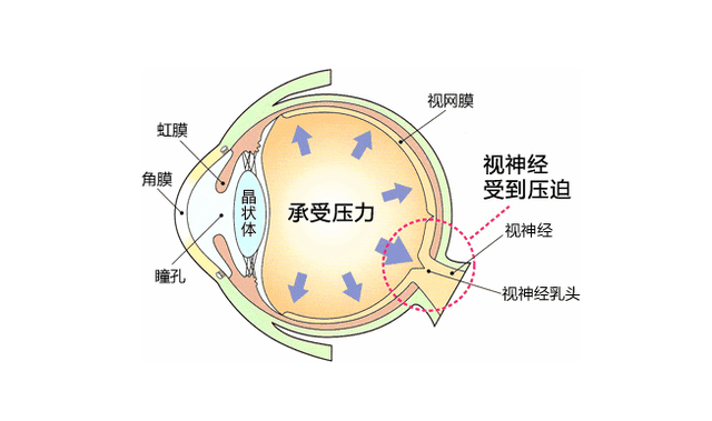 湖北普瑞眼科医院|眼压是个啥？为什么做近视手术前都要测眼压？