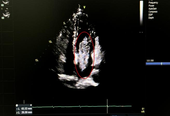 新突破！南昌大学二附院完成一例单孔胸腔镜下心脏肿瘤切除术