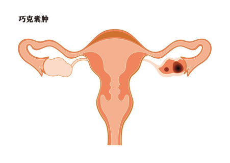 卵巢早衰更年期提前？听听医生怎么说