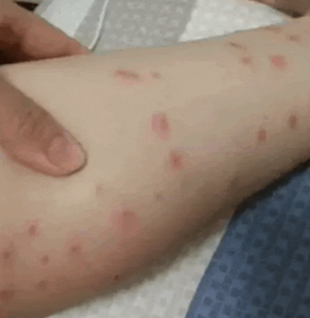 痒到挠出血！比蚊子还猛的「吸血鬼」