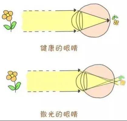 暑期摘镜总动员|近视手术能矫正近视，那散光呢？