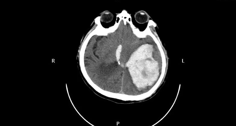 大面积脑出血图片