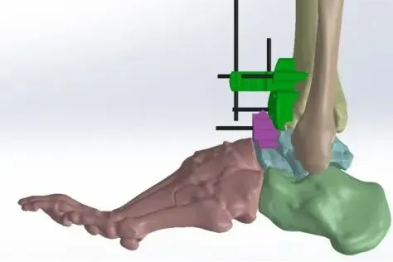 浙大四院骨科成功完成首例人工全踝关节置换