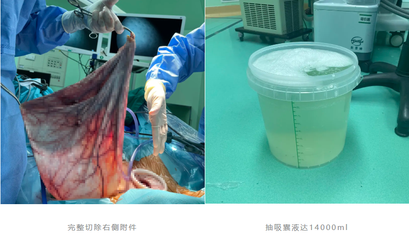 深圳市妇幼保健院成功完成一例巨大卵巢囊肿切除术