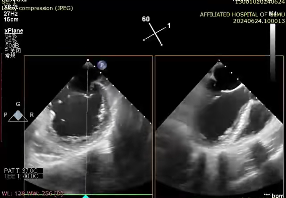 小「钳子」夹「漏风」丨桂医附院成功完成经导管二尖瓣钳夹术