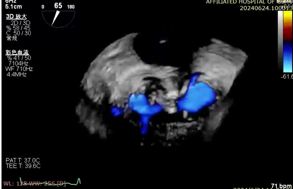 小「钳子」夹「漏风」丨桂医附院成功完成经导管二尖瓣钳夹术