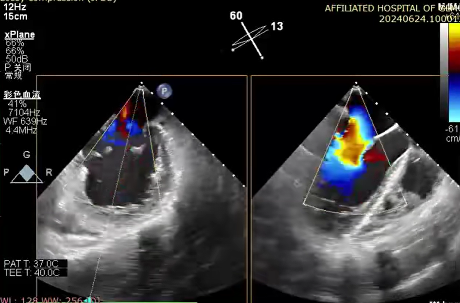 小「钳子」夹「漏风」丨桂医附院成功完成经导管二尖瓣钳夹术