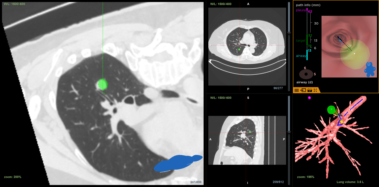 全省首例！南昌大学二附院完成一例肺结节 LungPro 导航下 BTPNA 术