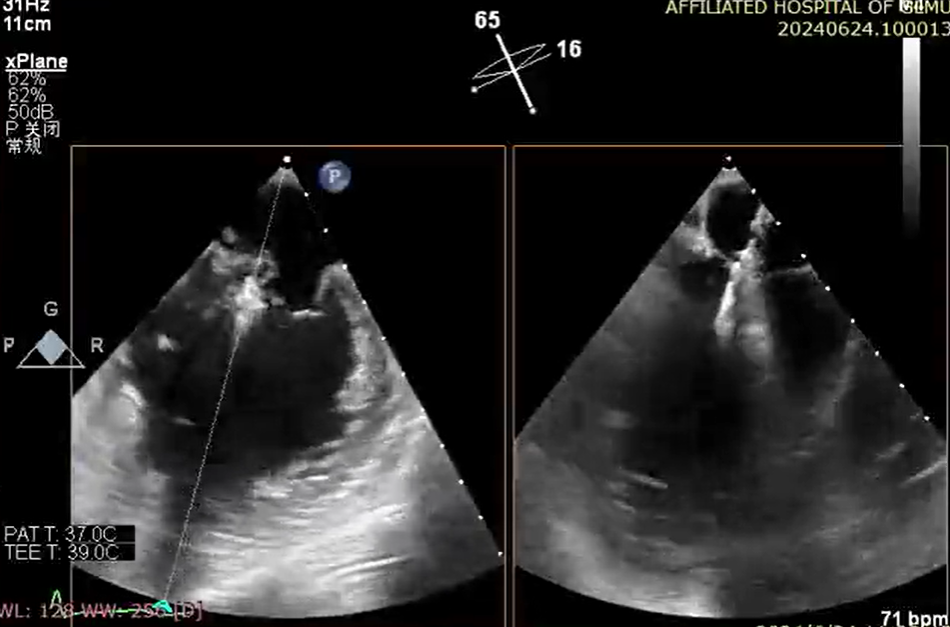 小「钳子」夹「漏风」丨桂医附院成功完成经导管二尖瓣钳夹术