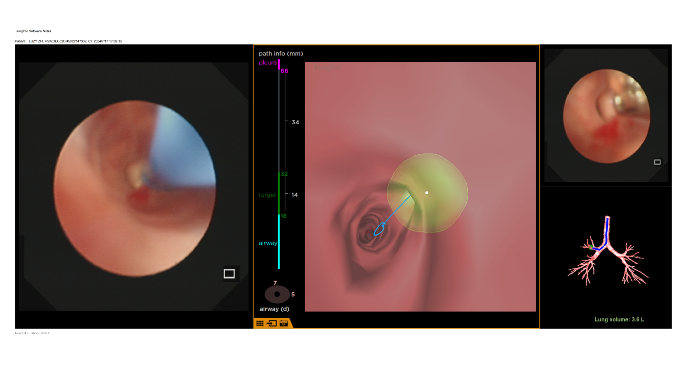 全省首例！南昌大学二附院完成一例肺结节 LungPro 导航下 BTPNA 术