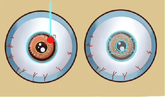 湖北普瑞眼科医院|关于近视手术的安全性，必须打破沙锅问到底！