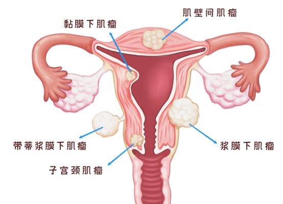 子宫肌瘤可以自己摸出来吗？