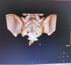 留置导尿超 10 年 机器人辅助手术助力 13 岁女孩摆脱排尿困扰