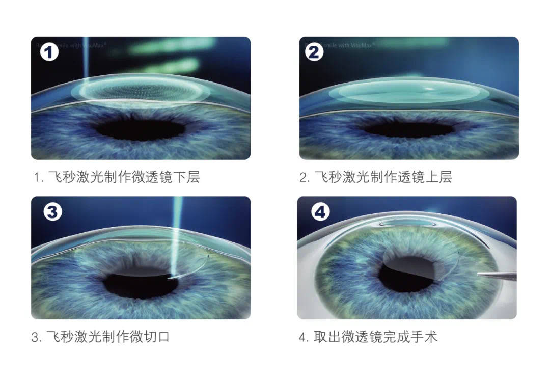 想做近视手术怎么办？湖北普瑞眼科医院一文告诉你