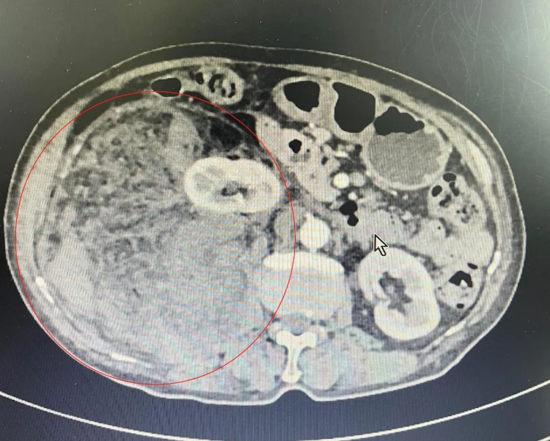 巨大肿瘤「霸占」腹部，这个团队抽丝剥茧精准「拆弹」