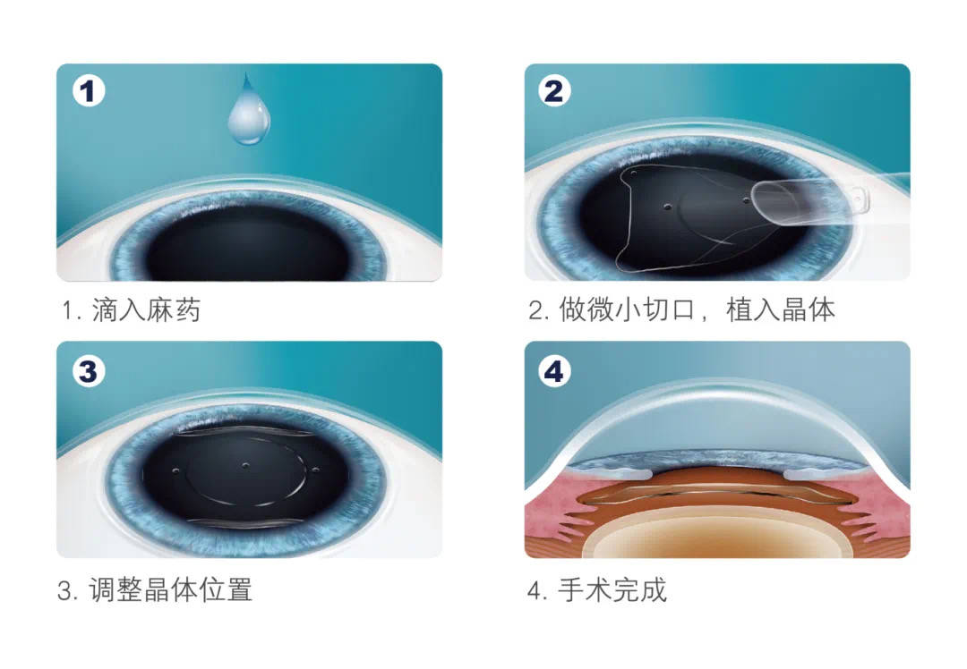 想做近视手术怎么办？湖北普瑞眼科医院一文告诉你