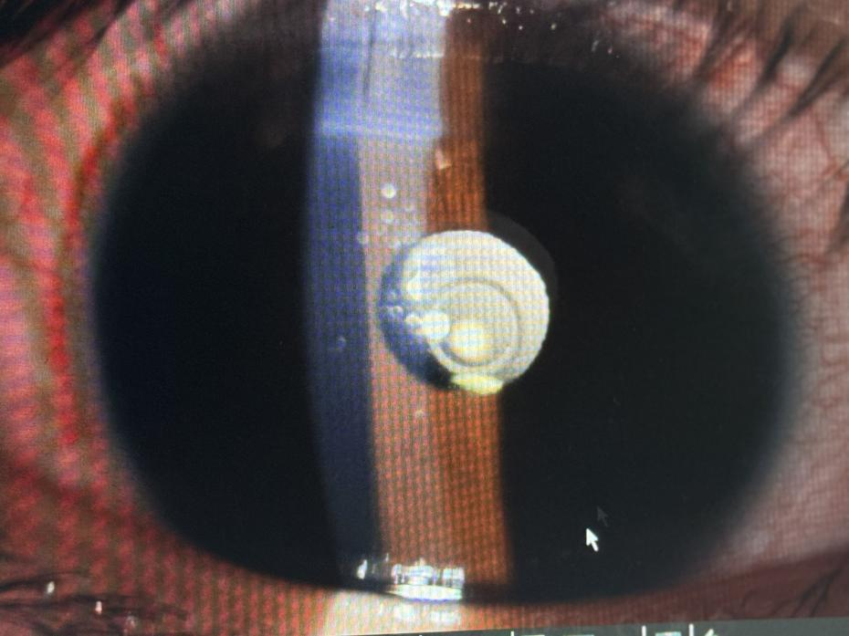 「马凡」少年晶体脱位 武汉普瑞眼科医院程旭康施高难手术给予光明