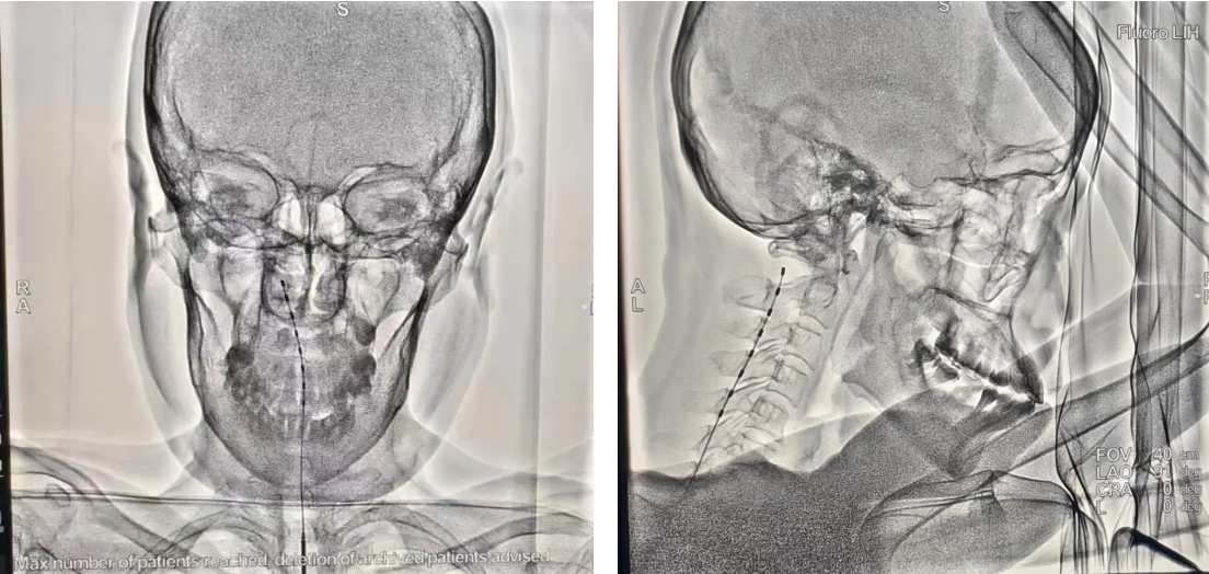 延大附院疼痛康复医学科完成陕北首例脊髓电刺激植入镇痛术
