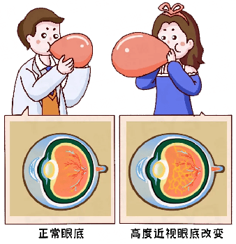湖北普瑞眼科医院|想做近视手术，医生却说我眼底破了个「洞」？