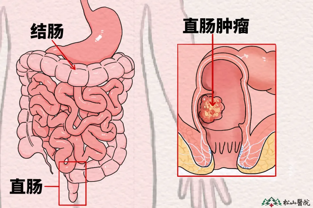 直肠后突图片