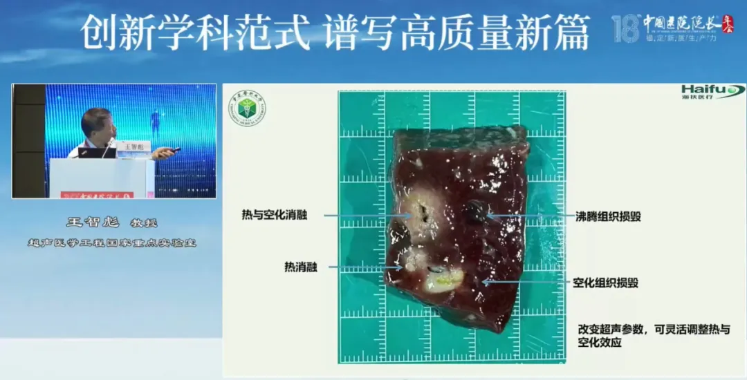 超声医学工程国家重点实验室主任王智彪教授谈聚焦超声消融治疗肝癌