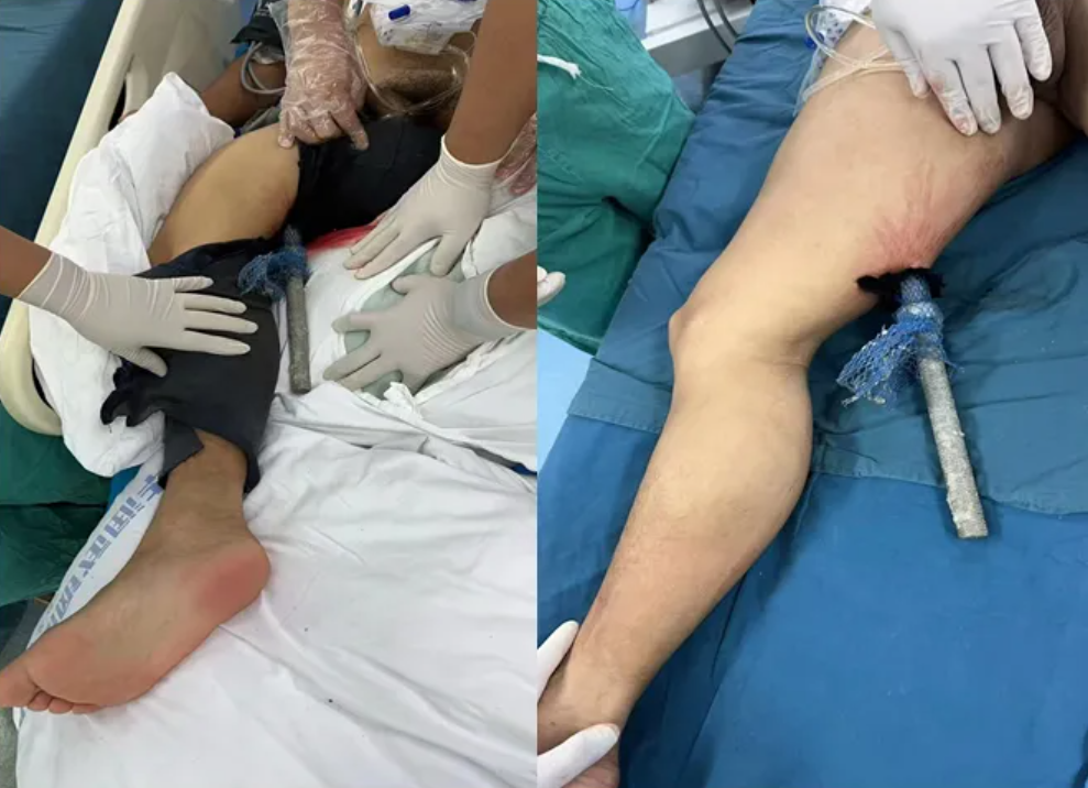 惊险!男子坠楼致钢筋穿体,华润武钢总医院创伤中心紧急救治化险为夷