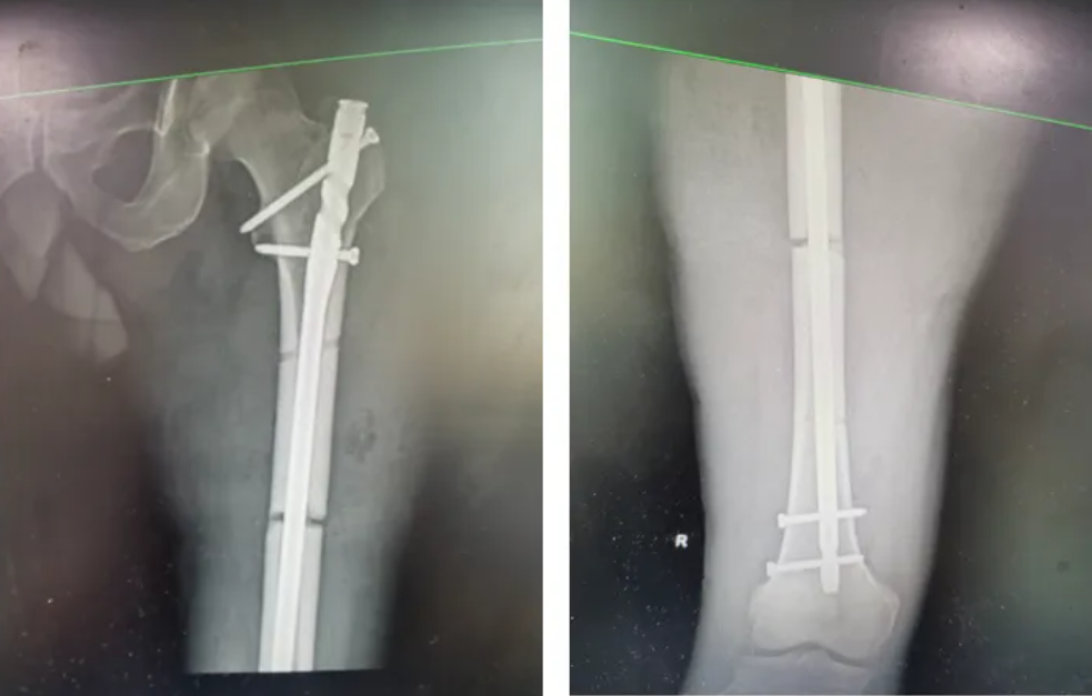 惊险!男子坠楼致钢筋穿体,华润武钢总医院创伤中心紧急救治化险为夷