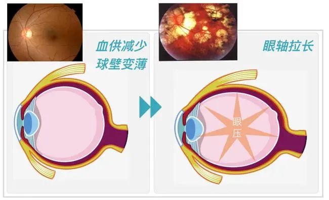 测眼压究竟查什么？有什么用呢？