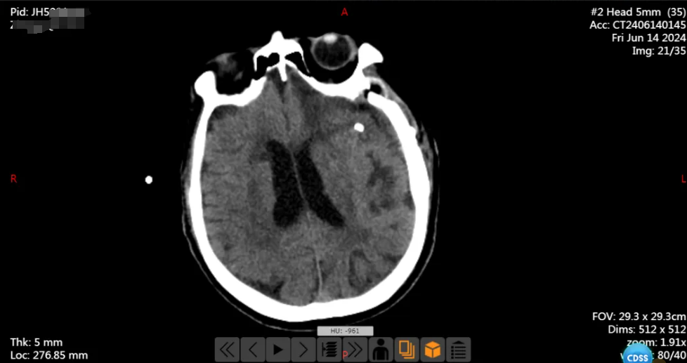 南京江北医院神经外科团队开展一例宽颈大脑中动脉瘤开颅夹闭术，拆除「颅内炸弹」