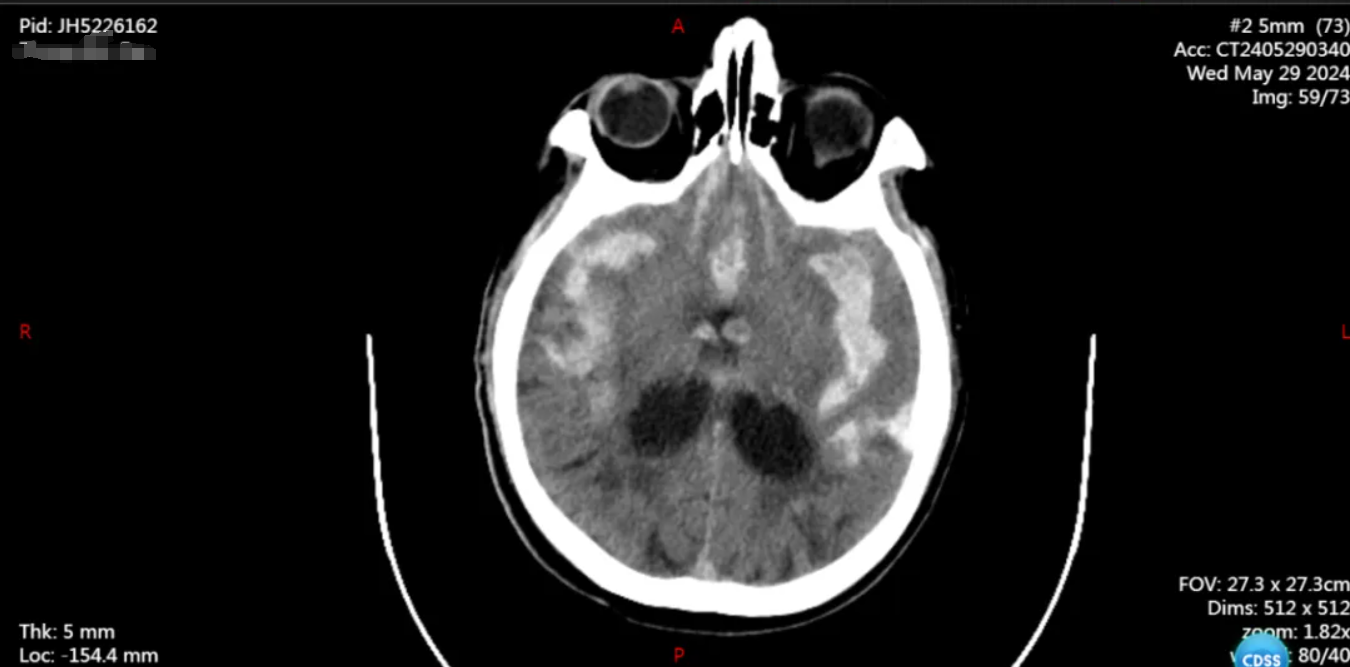 南京江北医院神经外科团队开展一例宽颈大脑中动脉瘤开颅夹闭术，拆除「颅内炸弹」