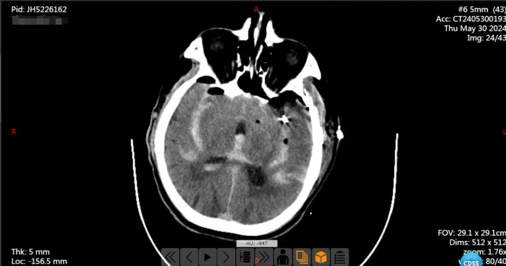 南京江北医院神经外科团队开展一例宽颈大脑中动脉瘤开颅夹闭术，拆除「颅内炸弹」