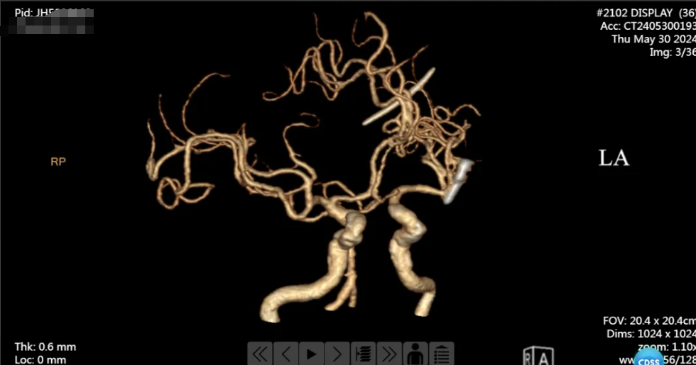 南京江北医院神经外科团队开展一例宽颈大脑中动脉瘤开颅夹闭术，拆除「颅内炸弹」