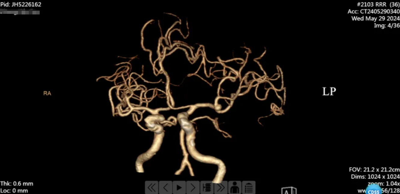 南京江北医院神经外科团队开展一例宽颈大脑中动脉瘤开颅夹闭术，拆除「颅内炸弹」