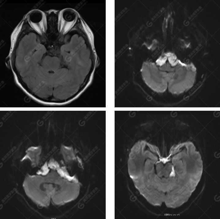 【高尚病例】胆脂瘤