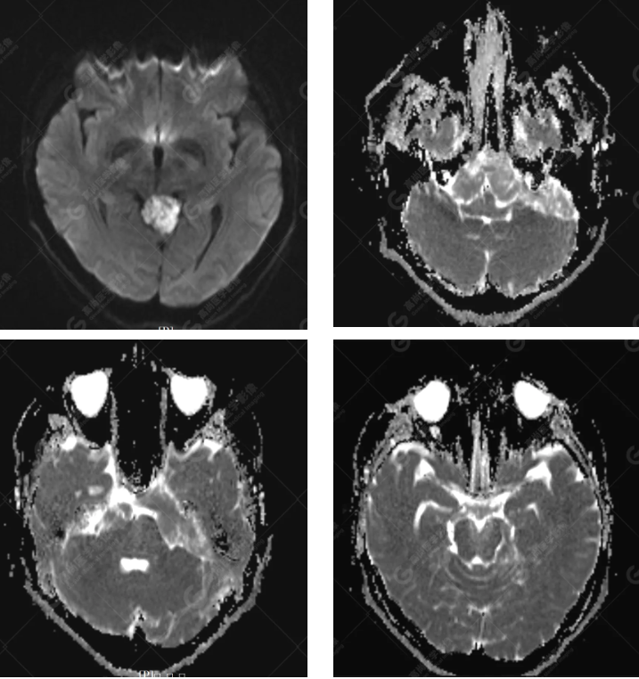 【高尚病例】胆脂瘤