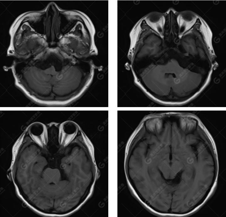 【高尚病例】胆脂瘤