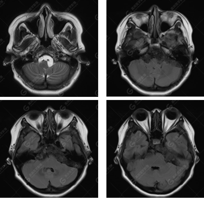 【高尚病例】胆脂瘤